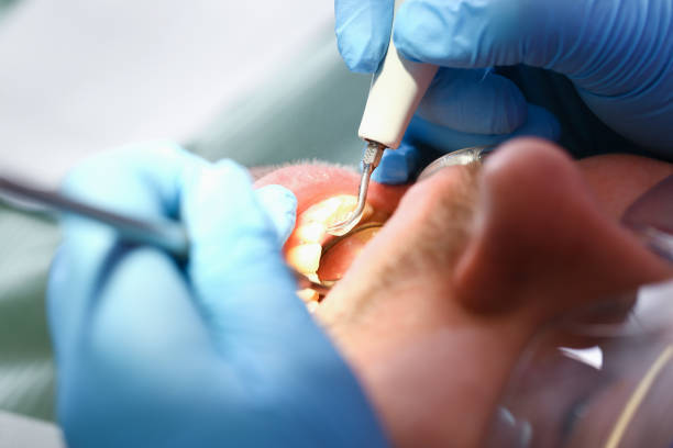 Best Dentist for Tooth Abscess  in Chowchilla, CA